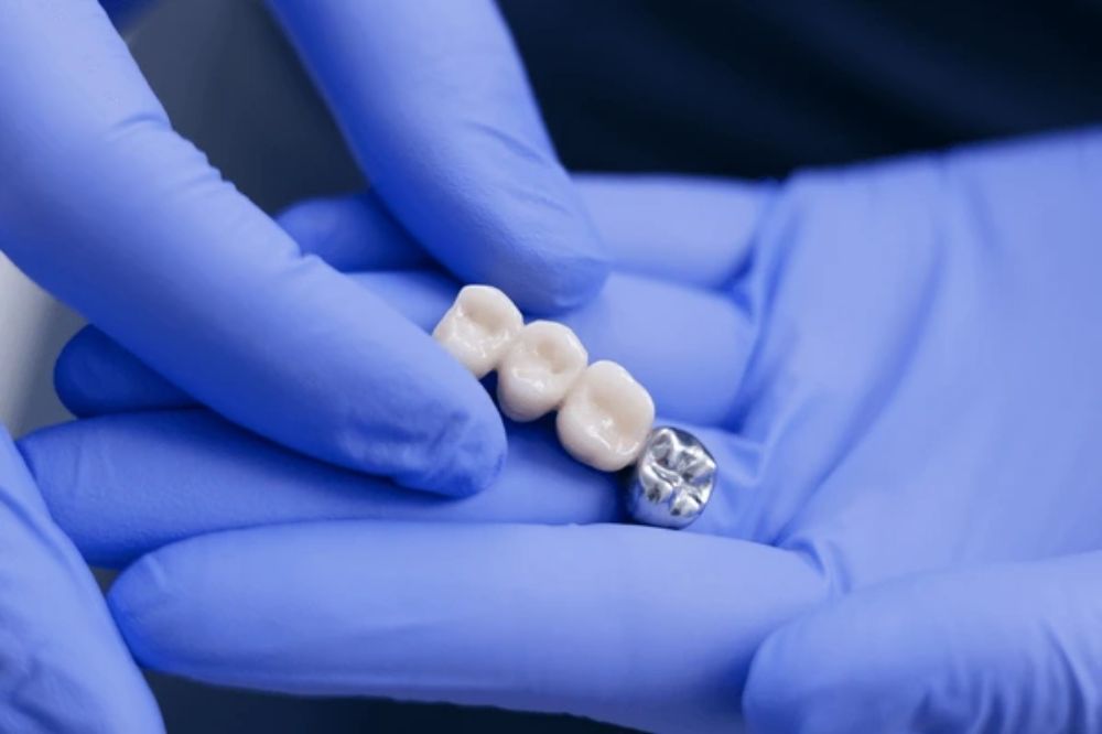 dental bridges in kingston ontario