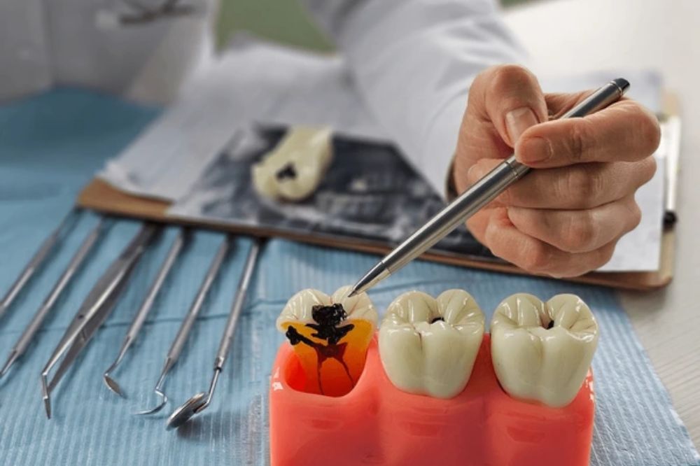 dental fillings in kingston ontario