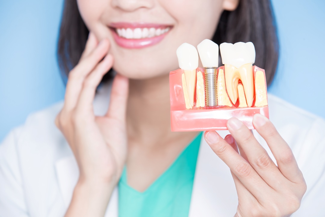 dental implants in kingston