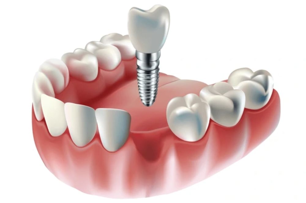 dental implants near you