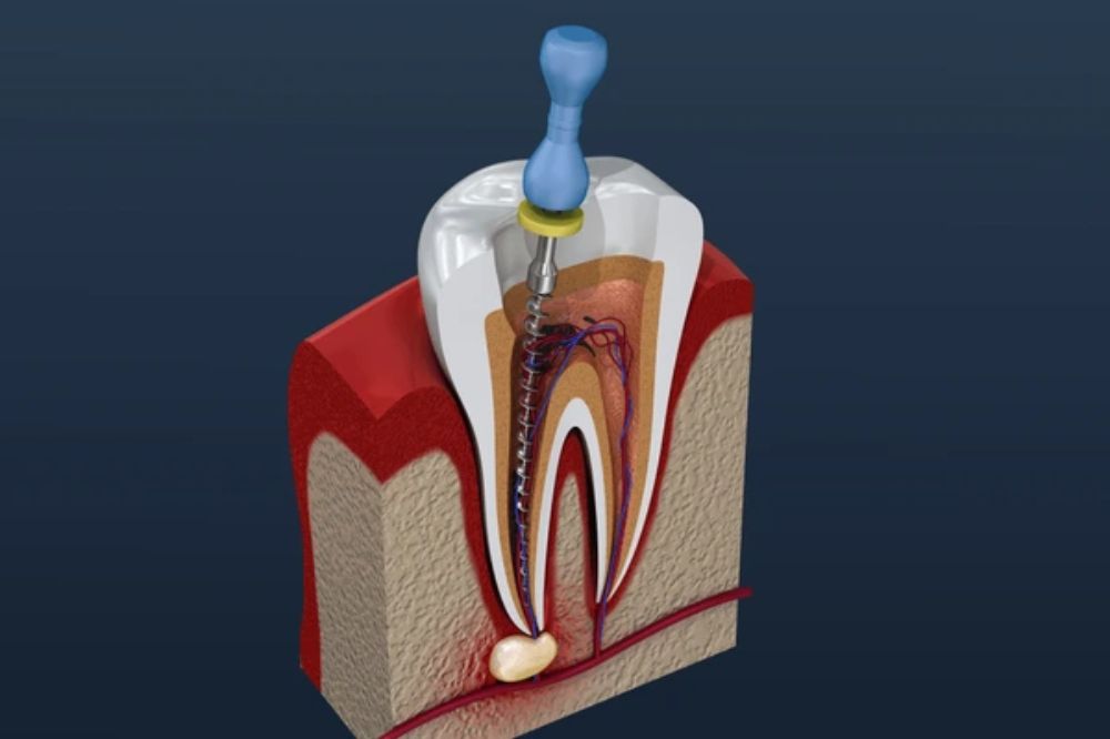 root canal therapy in kingston ontario